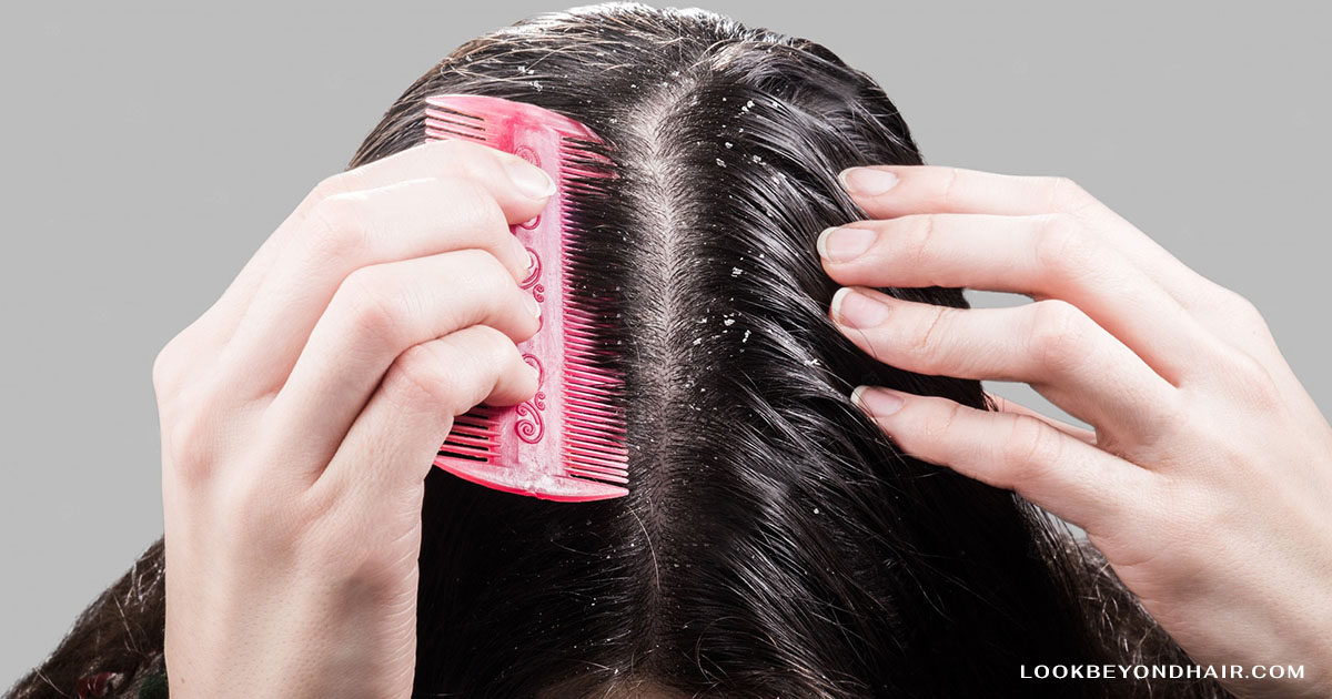 A Guide to Nourishing Your Scalp: Prevention and Lifestyle Tips for Fungal Infections