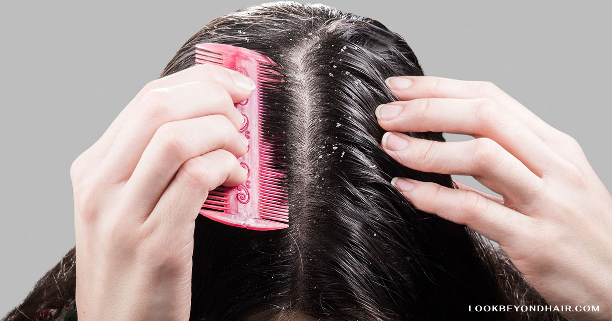 Prevention Tips for Scalp Fungal Infections