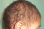 Monilethrix Genetic Hair Disorder