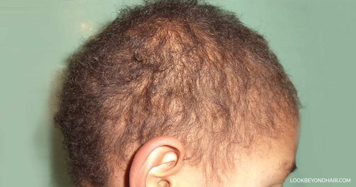 Monilethrix Genetic Hair Disorder